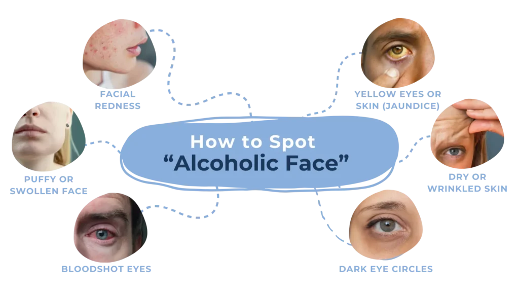 A Comprehensive Guide on How to Spot an Alcoholic Face